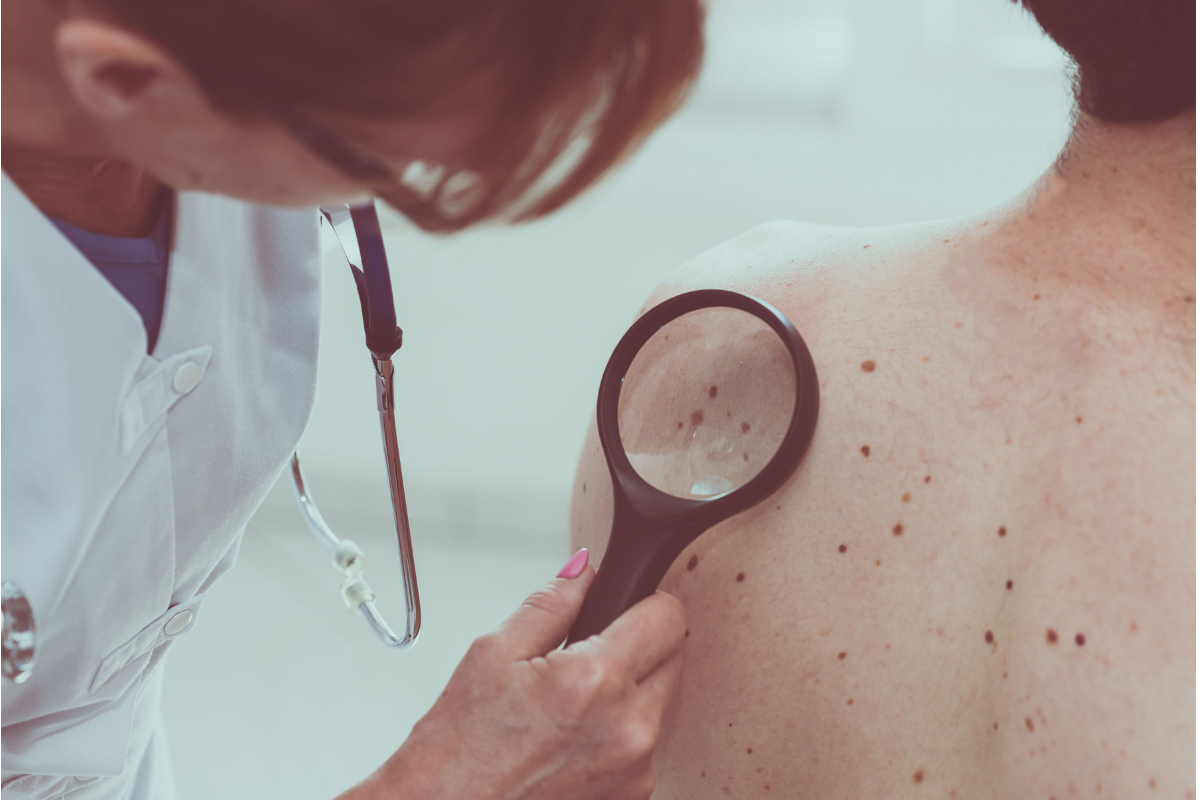 signs of late stage skin cancer